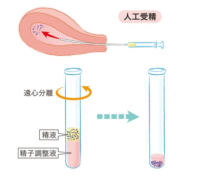 人工授精の手順